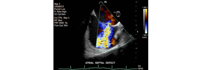 Echocardiography Cardiac Doppler Ultrasound