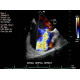 Echocardiography Cardiac Doppler Ultrasound