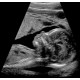 Limited OB Ultrasound for Pregnancy Care Centers