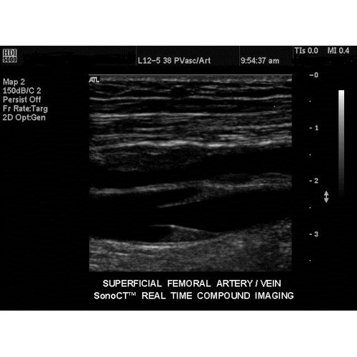 Peripheral Arterial Ultrasound