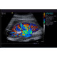 Renal Ultrasound with Doppler