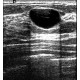Breast Ultrasound