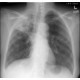 The Threat of Tuberculosis for Nurses (Online)