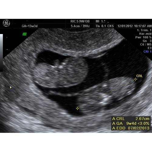 If this date is not felt to be accurate, providers turn to an early ultrasound for.